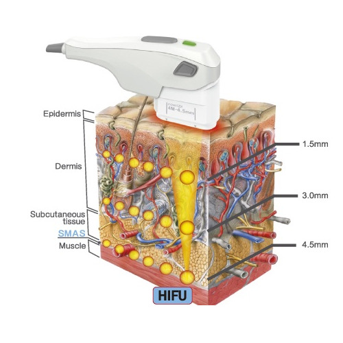 HIFU High Intensity Focused Ultrasound 